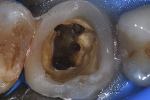 Endodoncja mikroskopowa Gniezno