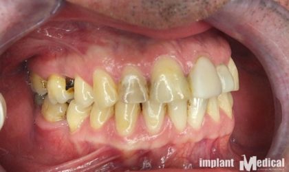 Pełne rekonstrukcje zgryzu na implantach i zębach własnych - Pacjent 10