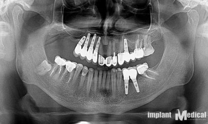 Pełne rekonstrukcje zgryzu na implantach i zębach własnych - Pacjent 11