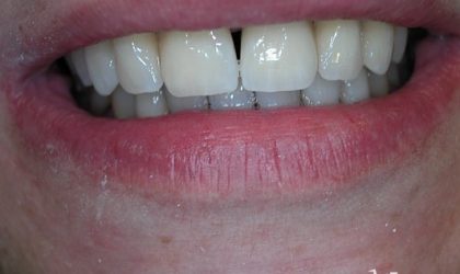 Pełne rekonstrukcje zgryzu na implantach i zębach własnych - Pacjent 12