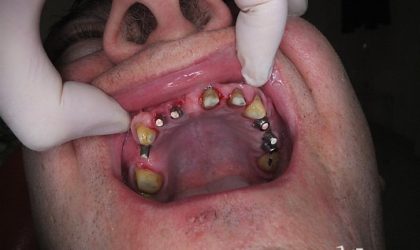 Pełne rekonstrukcje zgryzu na implantach i zębach własnych - Pacjent 13