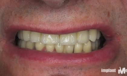 Pełne rekonstrukcje zgryzu na implantach i zębach własnych - Pacjent 13