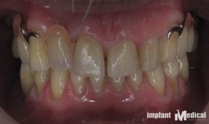 Pełne rekonstrukcje zgryzu na implantach i zębach własnych - Pacjent 14