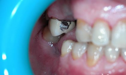 Pełne rekonstrukcje zgryzu na implantach i zębach własnych - Pacjent 15