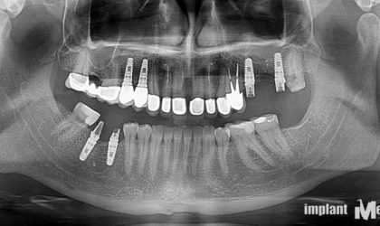 Pełne rekonstrukcje zgryzu na implantach i zębach własnych - Pacjent 15