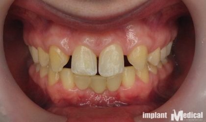 Pełne rekonstrukcje zgryzu na implantach i zębach własnych - Pacjent 16