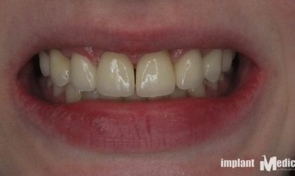 Pełne rekonstrukcje zgryzu na implantach i zębach własnych - Pacjent 16