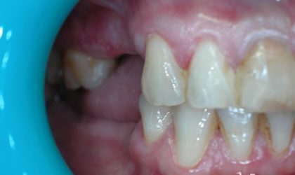 Pełne rekonstrukcje zgryzu na implantach i zębach własnych - Pacjent 18