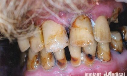 Pełne rekonstrukcje zgryzu na implantach i zębach własnych - Pacjent 1