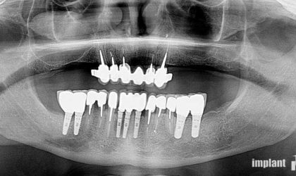 Pełne rekonstrukcje zgryzu na implantach i zębach własnych - Pacjent 1