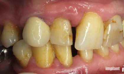 Pełne rekonstrukcje zgryzu na implantach i zębach własnych - Pacjent 2