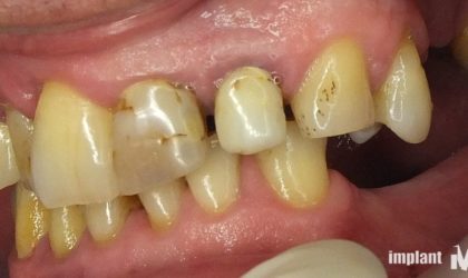 Pełne rekonstrukcje zgryzu na implantach i zębach własnych - Pacjent 2