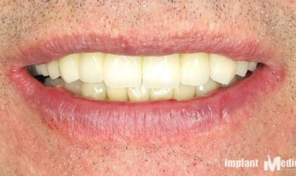 Pełne rekonstrukcje zgryzu na implantach i zębach własnych - Pacjent 3