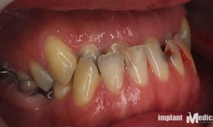 Pełne rekonstrukcje zgryzu na implantach i zębach własnych - Pacjent 4