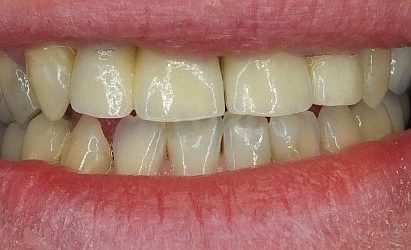 Pełne rekonstrukcje zgryzu na implantach i zębach własnych - Pacjent 4