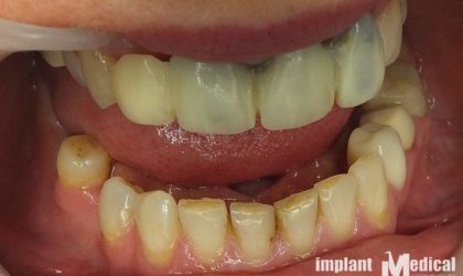 Pełne rekonstrukcje zgryzu na implantach i zębach własnych - Pacjent 6