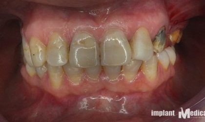 Pełne rekonstrukcje zgryzu na implantach i zębach własnych - Pacjent 7