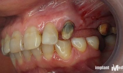 Pełne rekonstrukcje zgryzu na implantach i zębach własnych - Pacjent 7