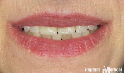 Pełne rekonstrukcje zgryzu na implantach i zębach własnych - Pacjent 8