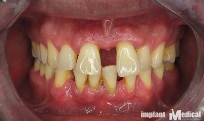 Pełne rekonstrukcje zgryzu na implantach i zębach własnych - Pacjent 9