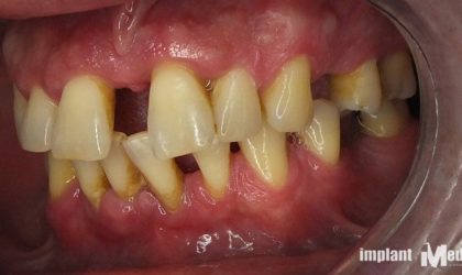 Pełne rekonstrukcje zgryzu na implantach i zębach własnych - Pacjent 9