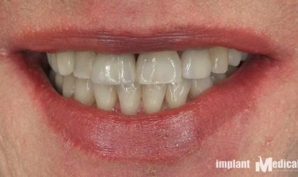 Pełne rekonstrukcje zgryzu na implantach i zębach własnych - Pacjent 18
