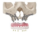 Implanty podokostnowe IUXTA-3D 02